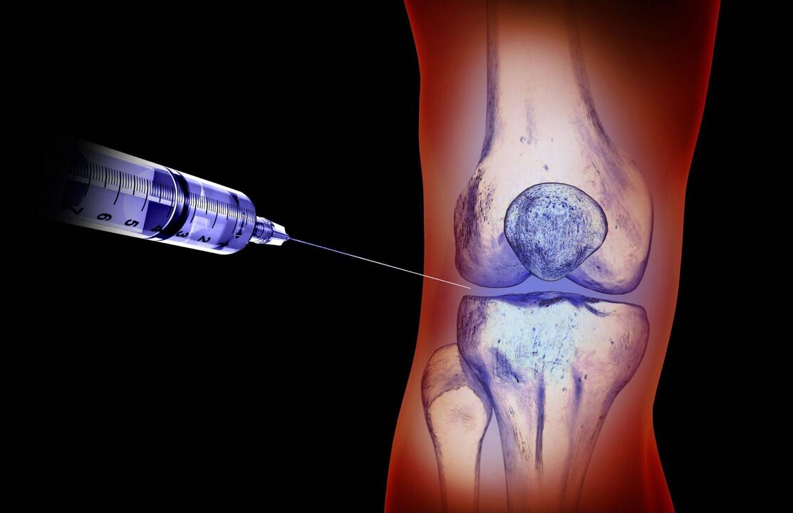 Intra-articular injections in arthrosis