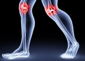 Causes of Development of Knee Arthrosis