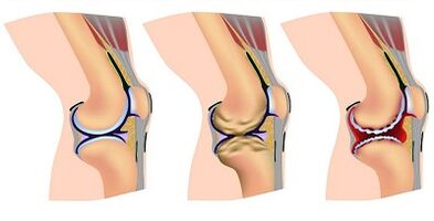 Stages of Development of Knee Arthrosis