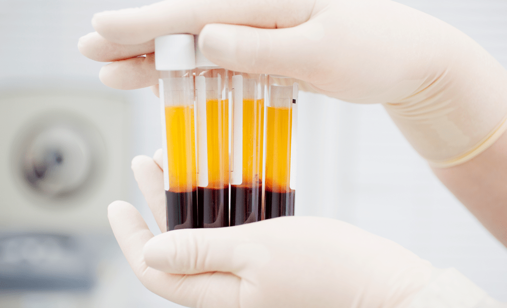 Platelet-rich plasma for PRP therapy of arthrosis
